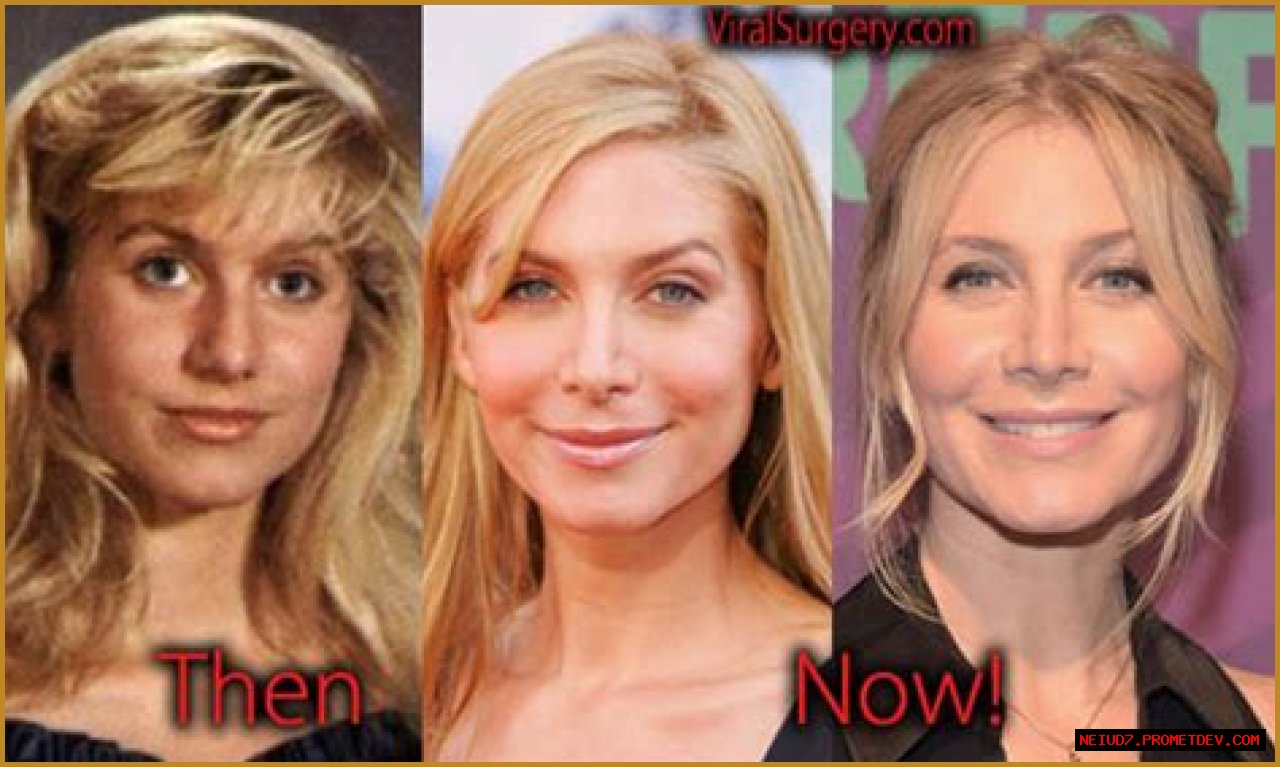 Elizabeth Mitchell Plastic Surgery Before and After